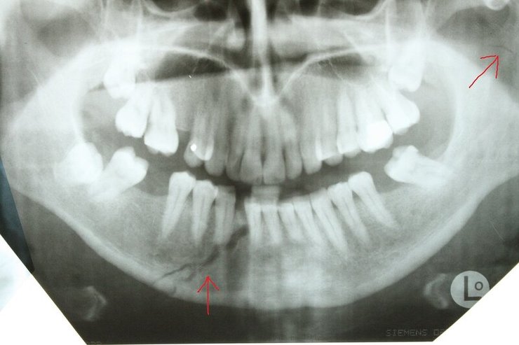 Сломанная в результате ДТП челюсть Адама Кадырова сломана в результате ДТП